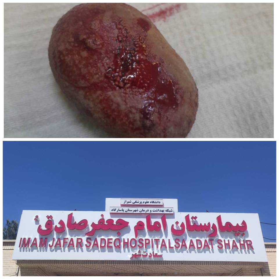 جراحی موفق سنگ مثانه در بیمارستان امام جعفر صادق(ع) پاسارگاد